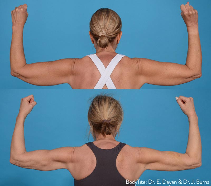 bodytite-before-after-dr-e-dayan-dr-j-burns-preview-1