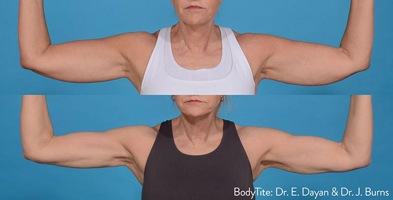 bodytite-before-after-dr-e-dayan-dr-j-burns-preview-2